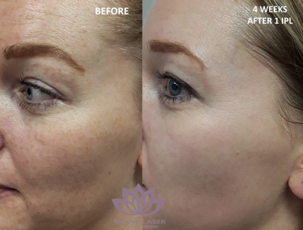 IPL Before And After NEW - Revive Laser And Skin Clinic