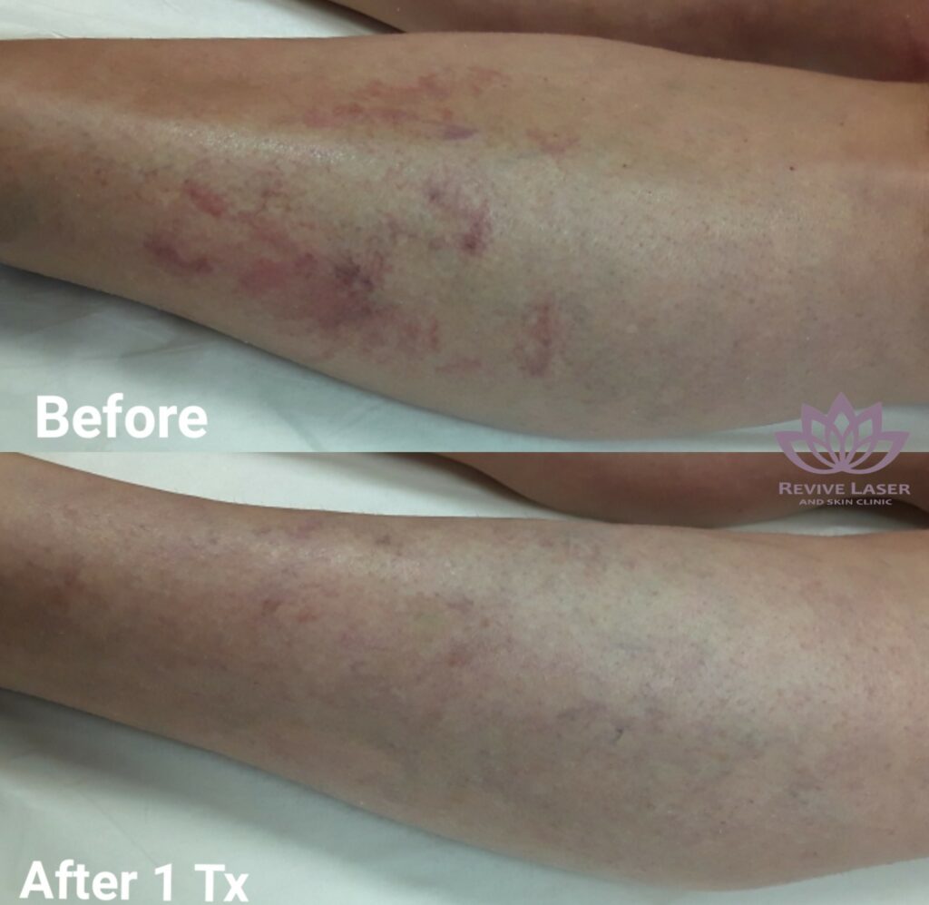 Vein Treatment Before And After 2 Revive Laser And Skin