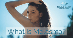 What is melasma blog cover - Revive Laser