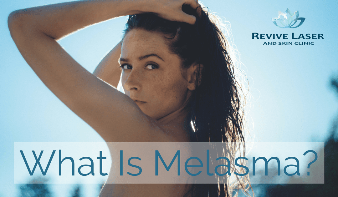 What is Melasma?