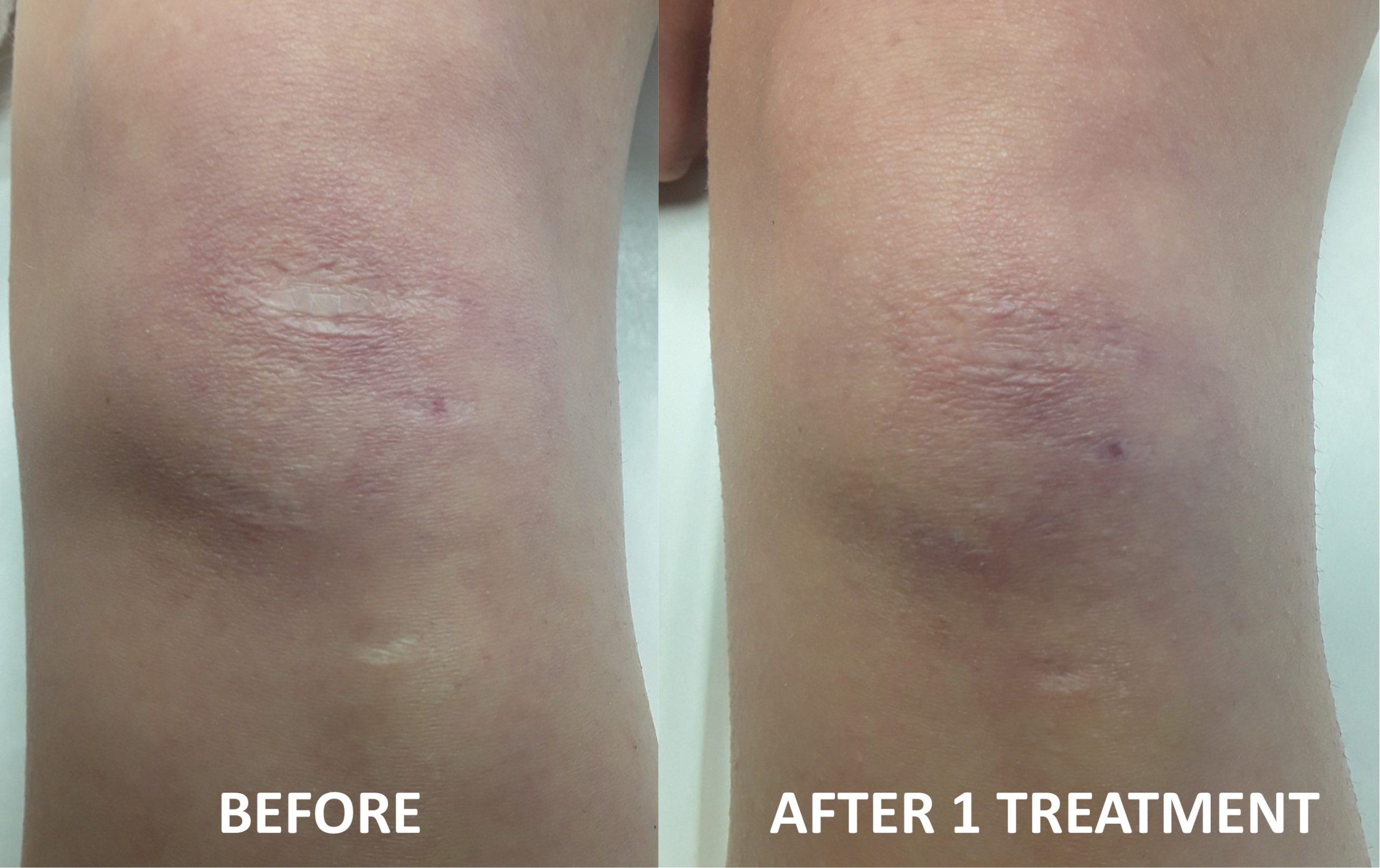 SCAR BEFORE AND AFTER 1 TREATMENT - Revive Laser and Skin Clinic