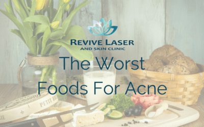 The Worst Foods For Acne