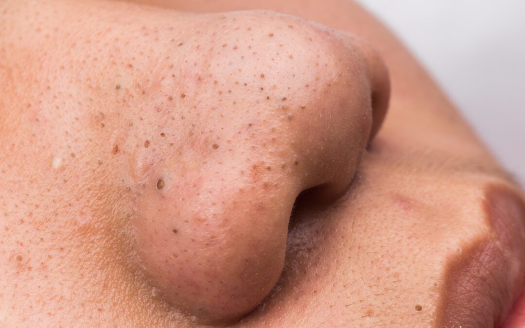 close up of blackheads in nose - Revive Laser