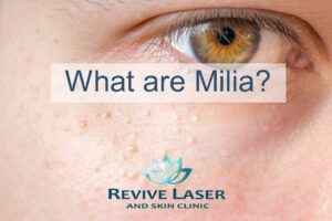 Milia photo - Revive Laser