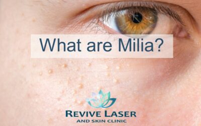 What are Milia?