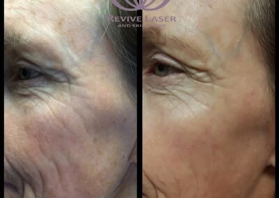 4D laser skin treatment | Revive Laser