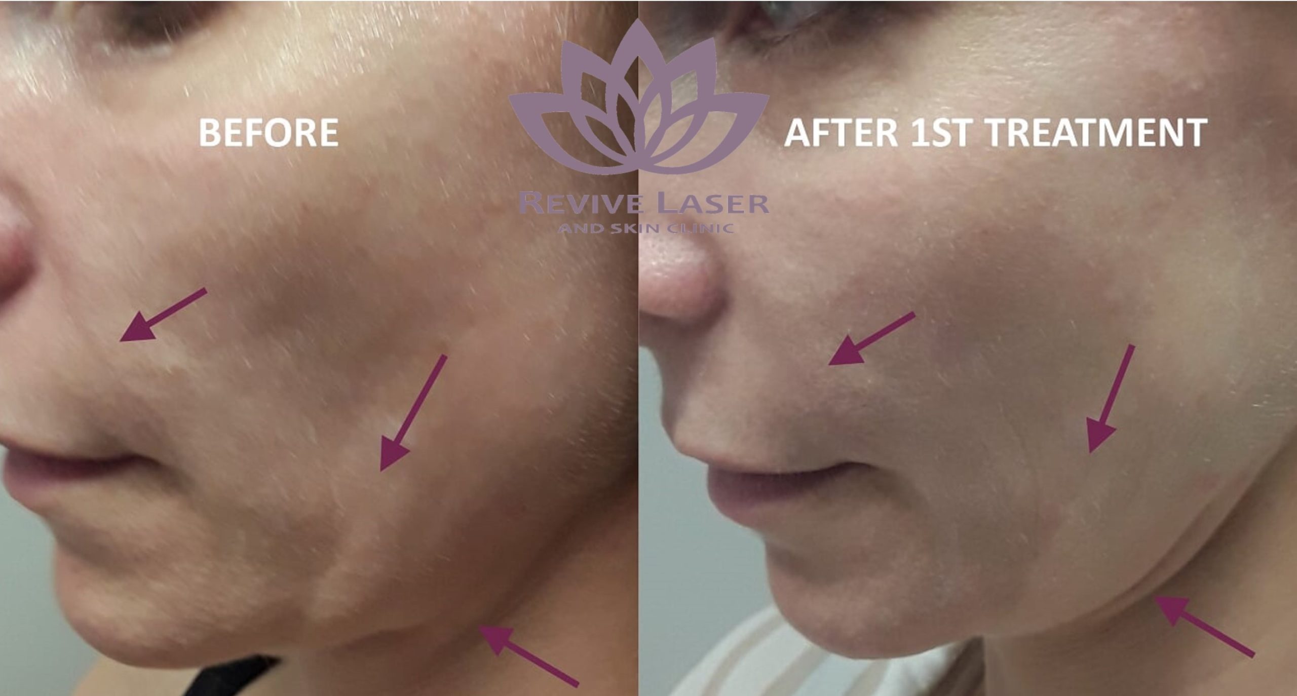 Laser Skin Tightening Before And After Revive Laser And Skin Clinic