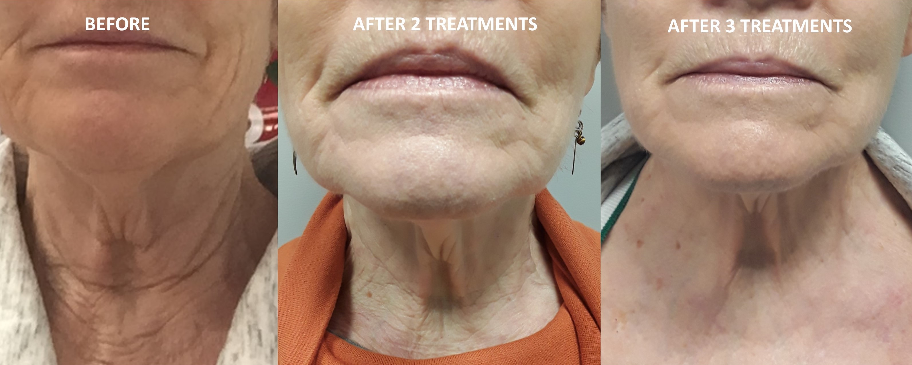 Neck Tightening Before And After Revive Laser And Skin Clinic