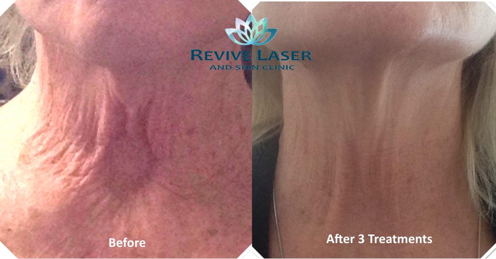 Neck tightening - before and after - Revive Laser and Skin ...