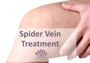 spider veins on thigh | Revive Laser