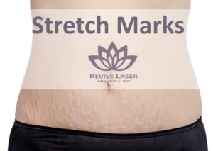 stretch marks on stomach | Revive Laser
