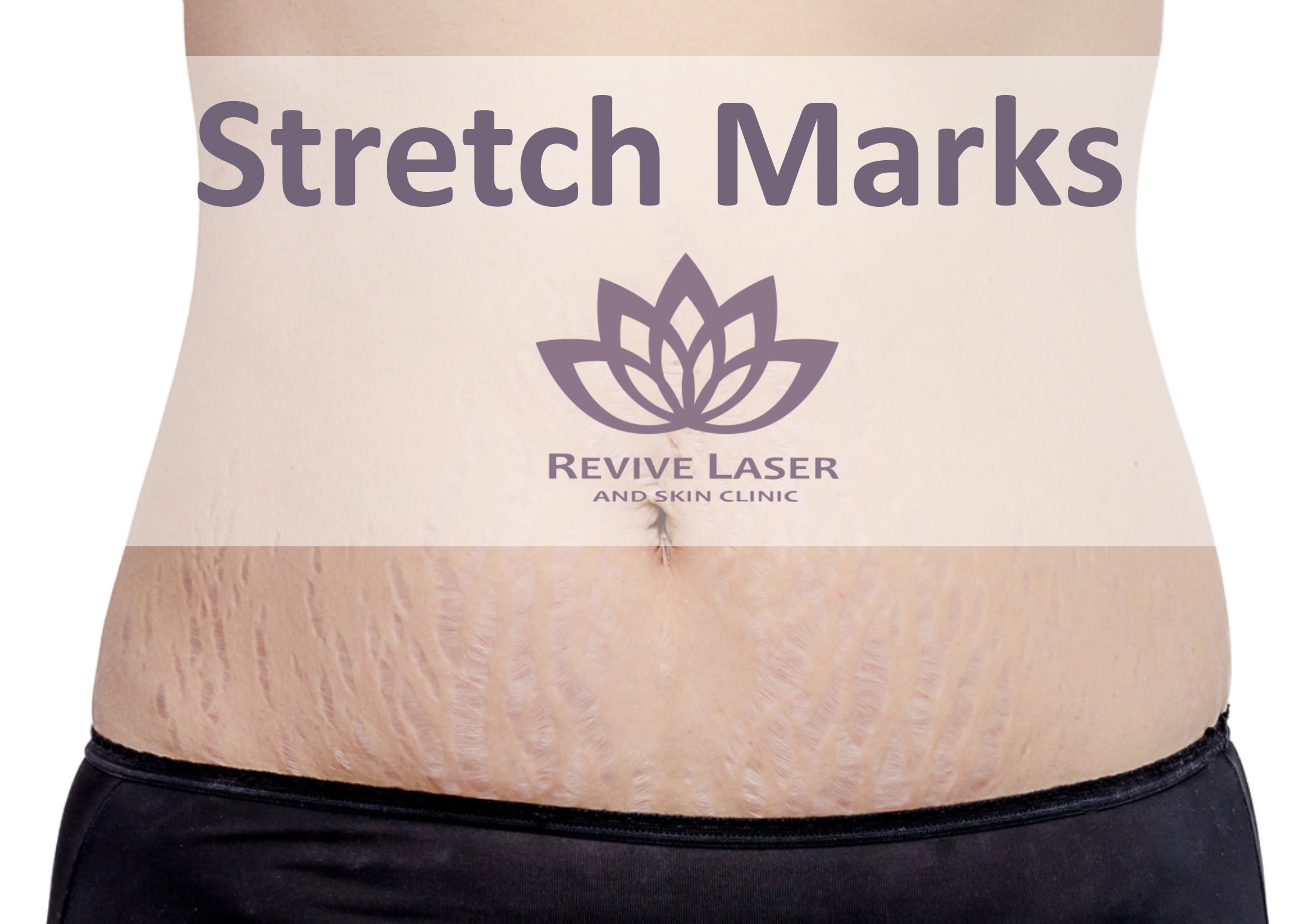Can Yoga Help Reverse Stretch Marks? - Plastic Surgery Skin Clinic