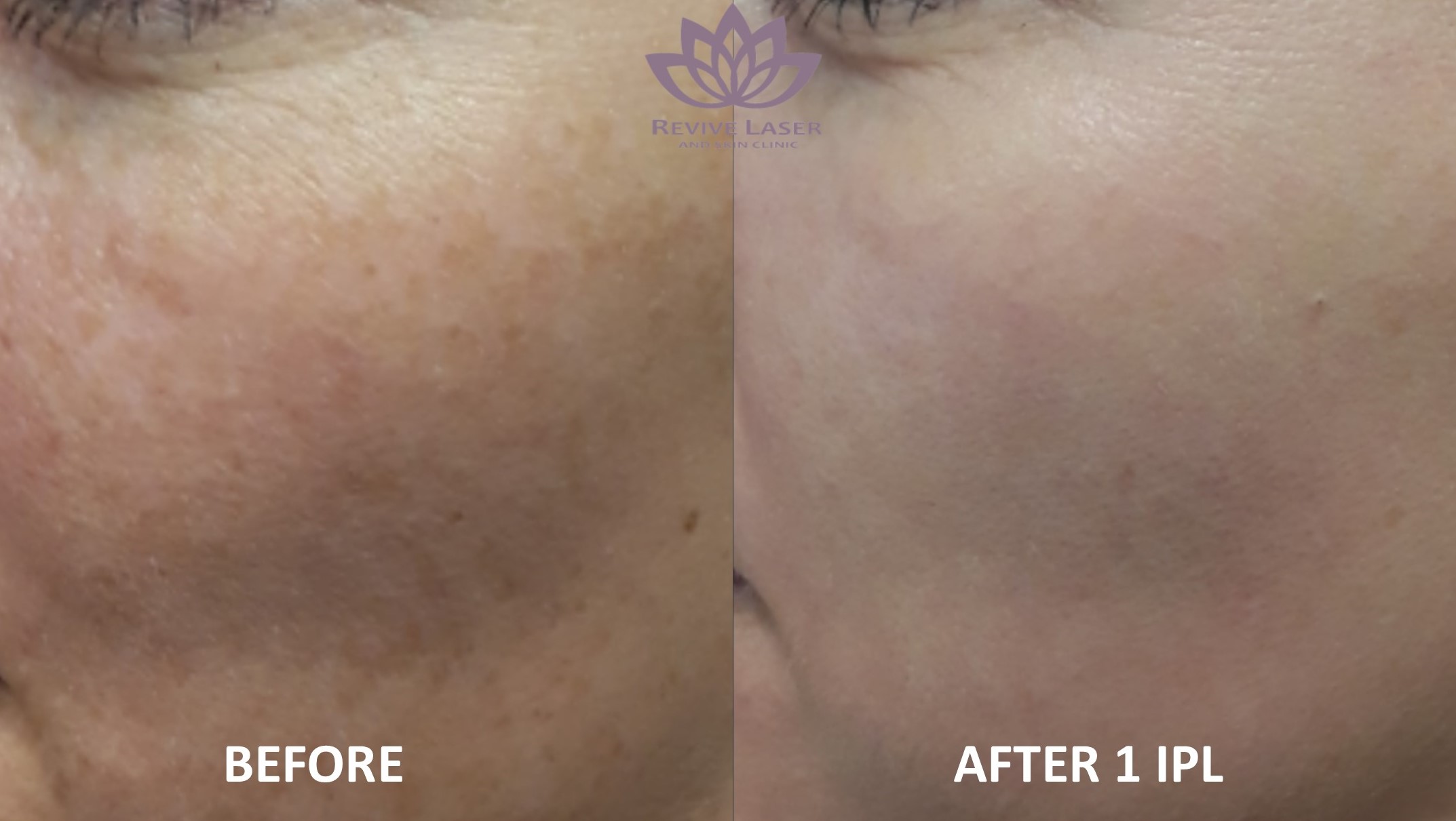 ipl BEFORE AND AFTER 3 - Revive Laser and Skin Clinic