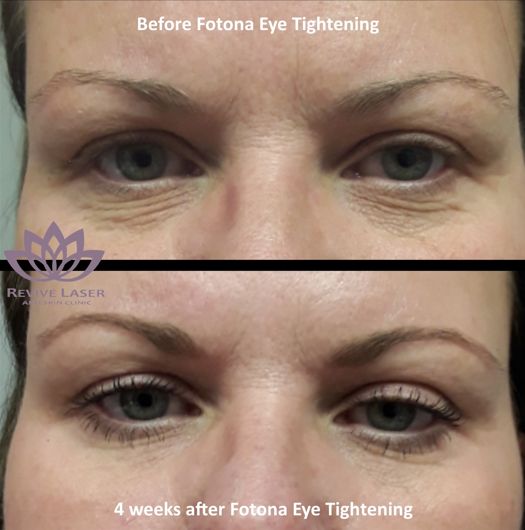 Laser Under Eye Bag Treatment - Vbotanique Beauty Cosmetics Clinic