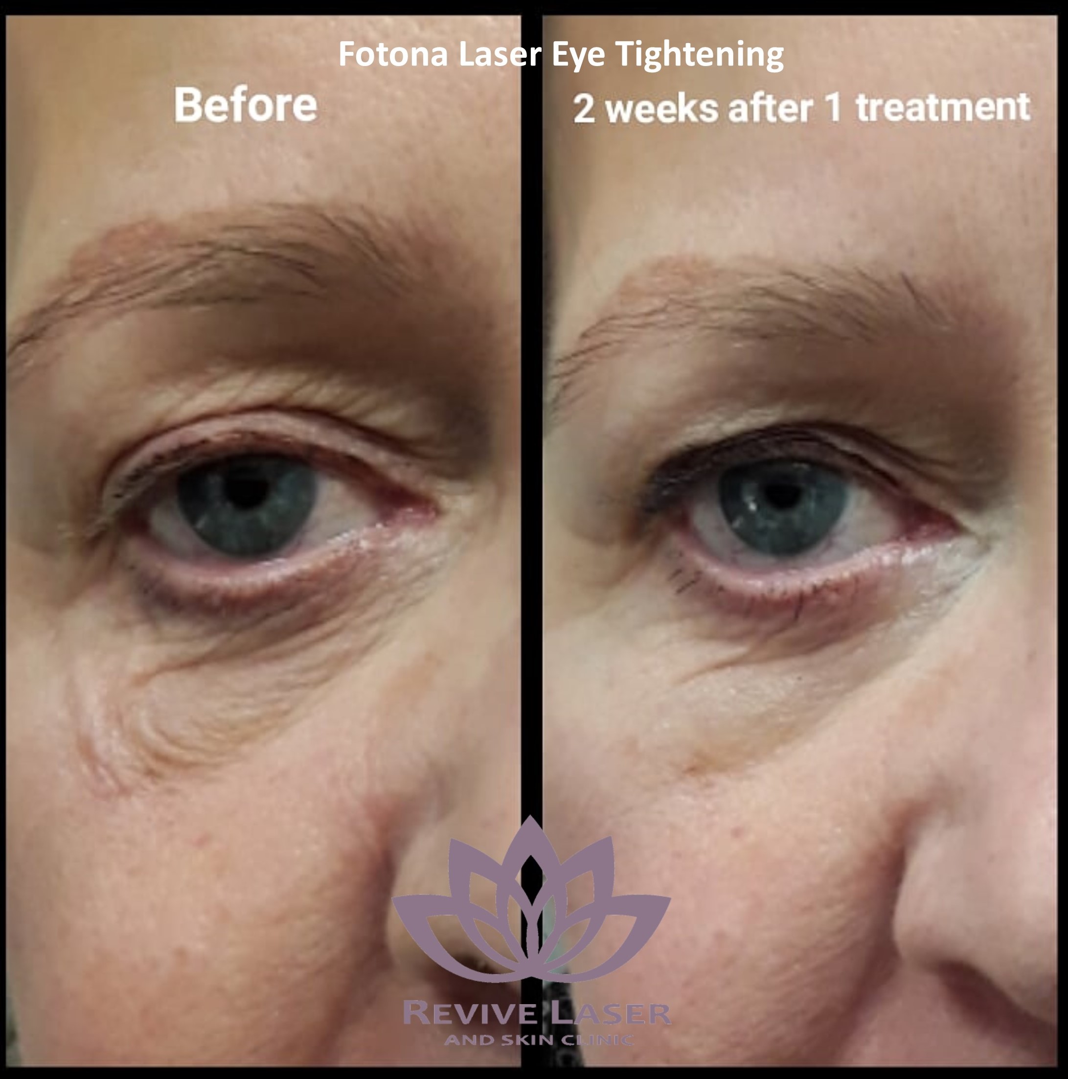 Dr Rita Rakus Clinic - It's never too late...The new minimally invasive  laser treatment Endolift can help to eliminate eye bags - contact the Dr  Rakus Clinic now to book an appointment