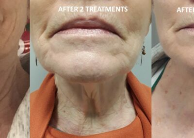 neck tightening before and after - Revive Laser